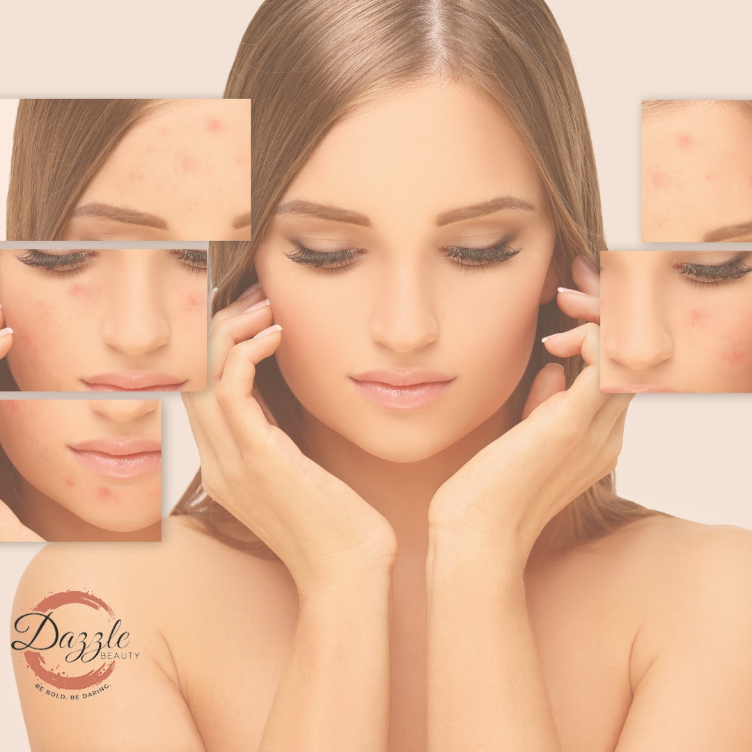Defeat Summer Acne with Expert Tips !!